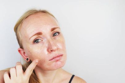 home-remedies-for-oily-skin-that-work-well